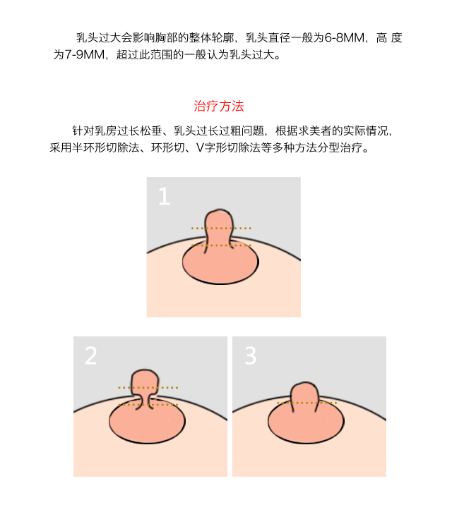 乳头缩小多少钱?